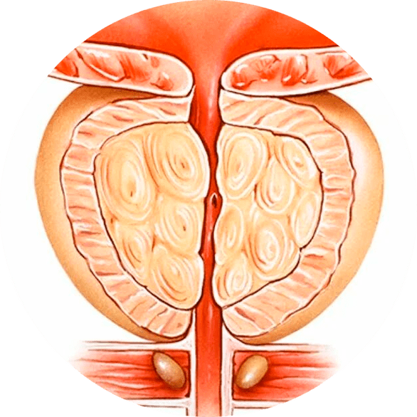 Consequences of untreated prostatitis