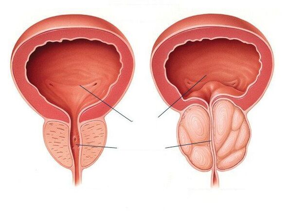 healthy and sick prostate